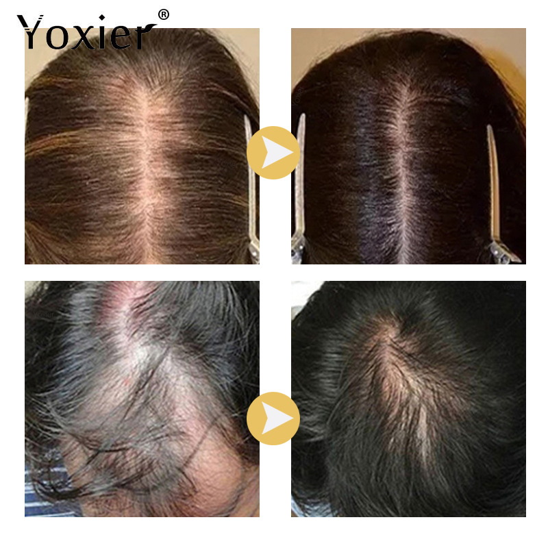Сыворотка для интенсивного рос – обзор и цена Hair Care For Hair Loss